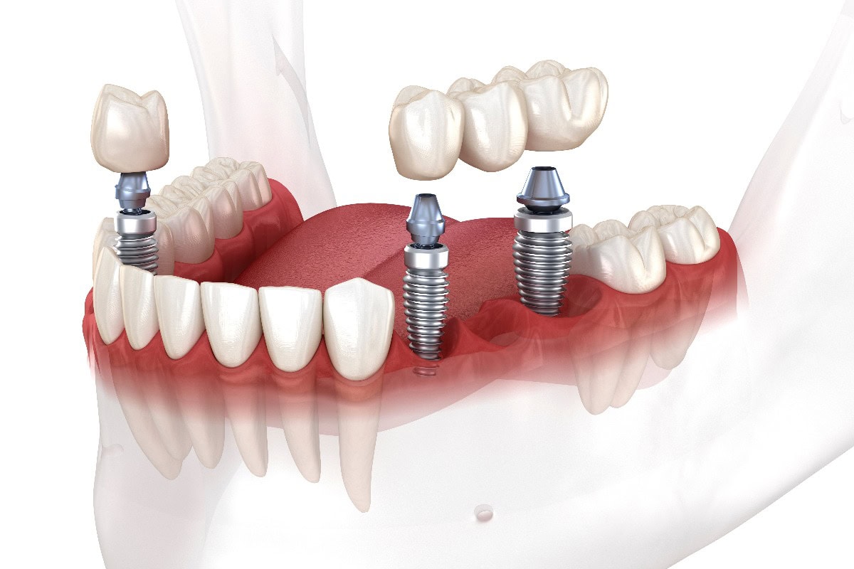 Einsetzen einer Zahnbrücke und einer Krone über Implantaten. Zahnärztliches 3D-Illustrationskonzept