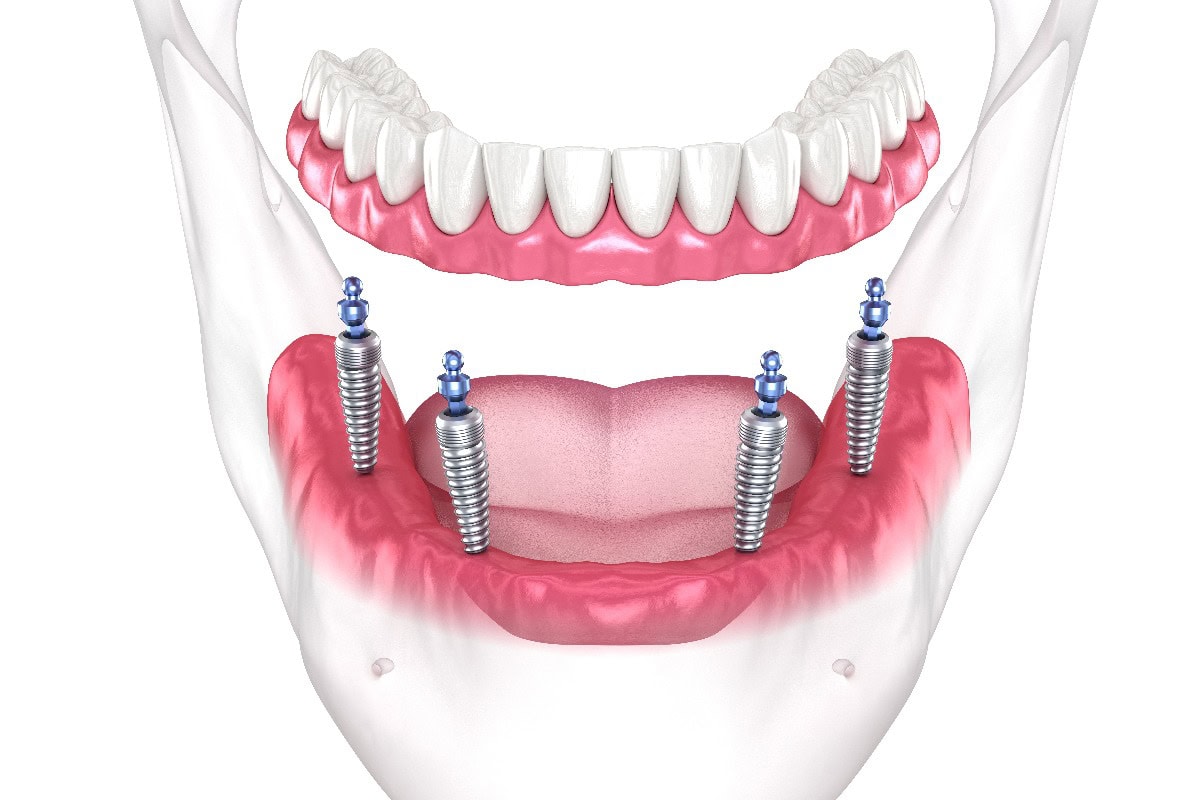 Herausnehmbare Unterkieferprothese All on 4 System, getragen von Implantaten mit Kugelattachments. Medizinisch exakte zahnmedizinische 3D-Darstellung