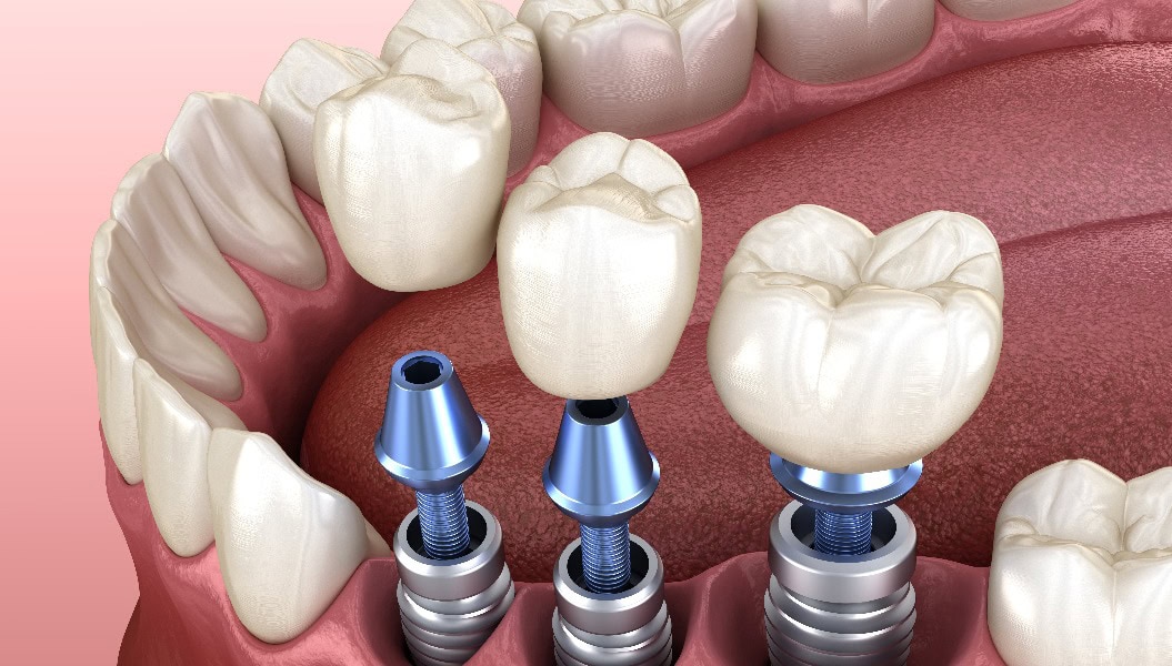 Platzierung von 3 Zahnkronen über 3 Implantaten - Konzept. 3D-Illustration von menschlichen Zähnen und Zahnersatz