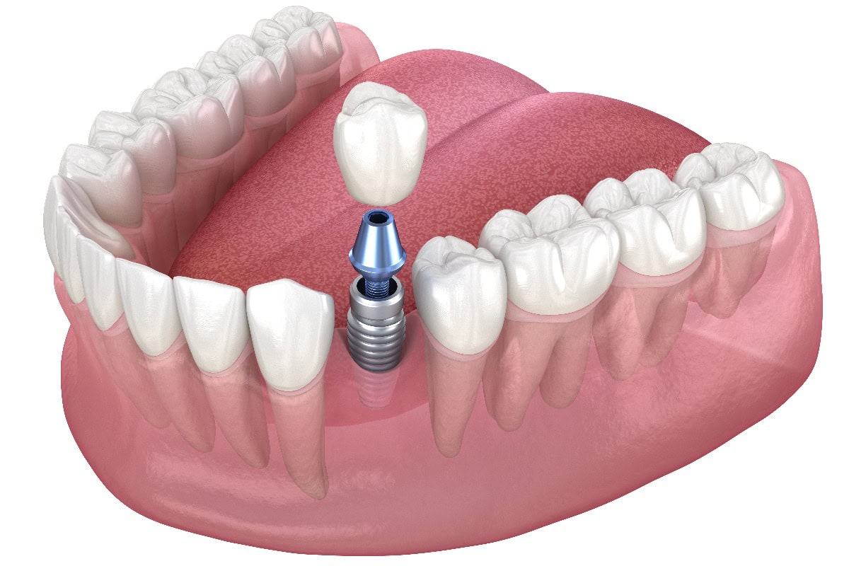 Wiederherstellung eines Backenzahns mit Implantat. Medizinisch akkurate 3D-Illustration von menschlichen Zähnen und einem Zahnersatzkonzept